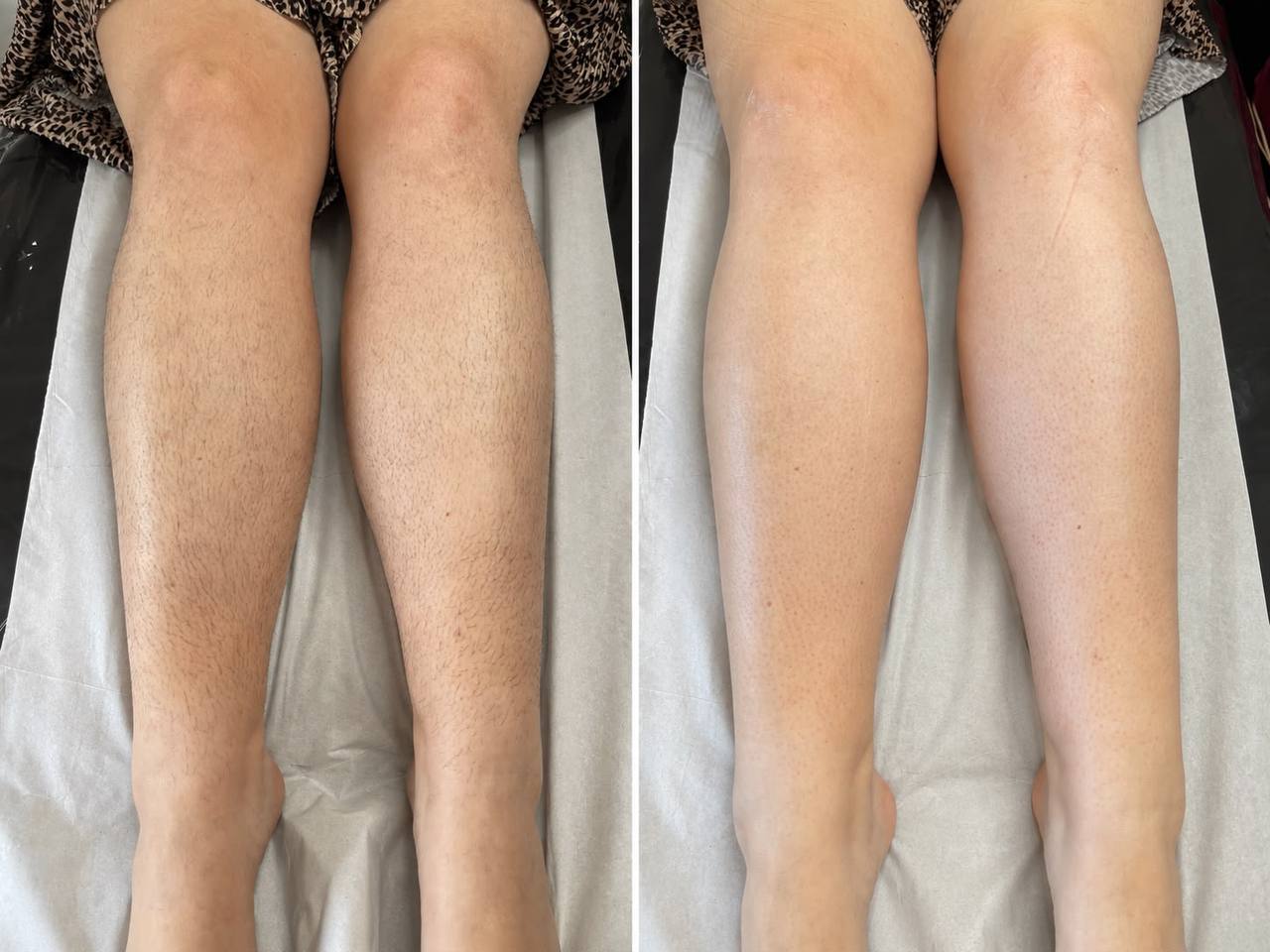 Before and after leg waxing result